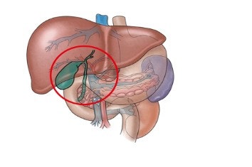 담낭암 완전 정리: 원인부터 증상, 진단, 치료, 예후까지 한 번에 이해하기