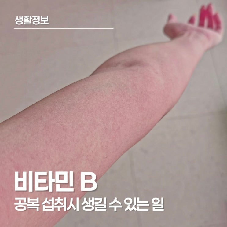  비타민 공복에 먹어도 될까? 실제로 겪은 비타민 B 부작용 경험