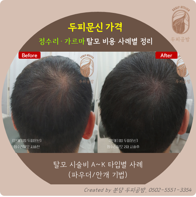  두피문신 가격 | 정수리·가르마 탈모 비용 사례별 정리 (두피공방, 40~120만원)
