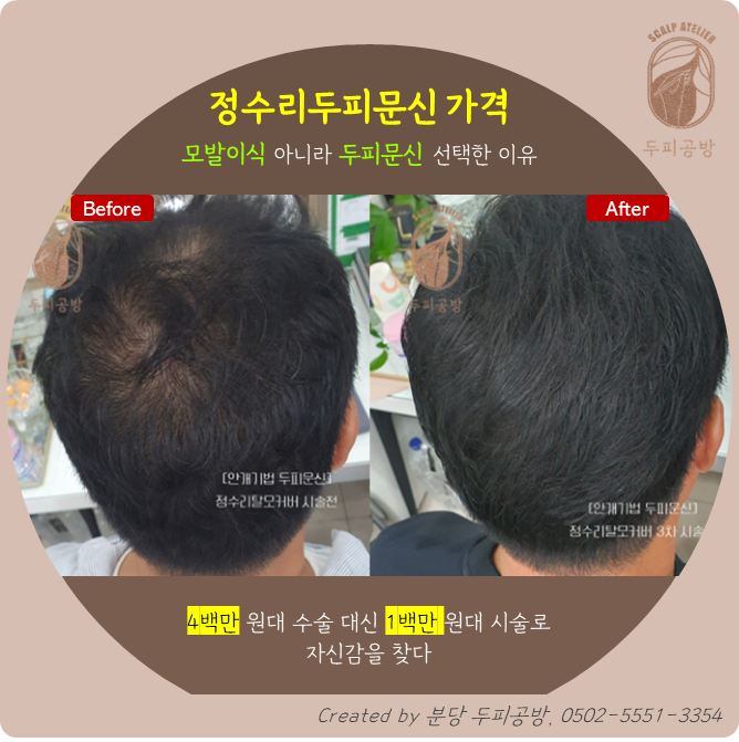  [성남두피문신] 모발이식 대신 두피문신을 선택한 이유 ㅣ50대 남성 고객 사례