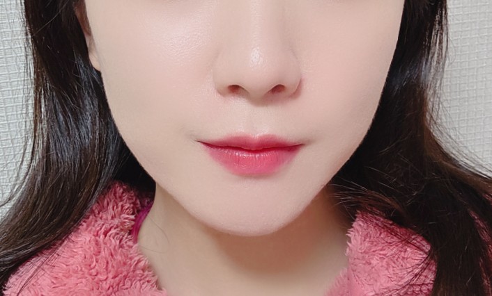  방배동피부과 올타이트 400샷 리프팅 가격 유지기간 효과 후기