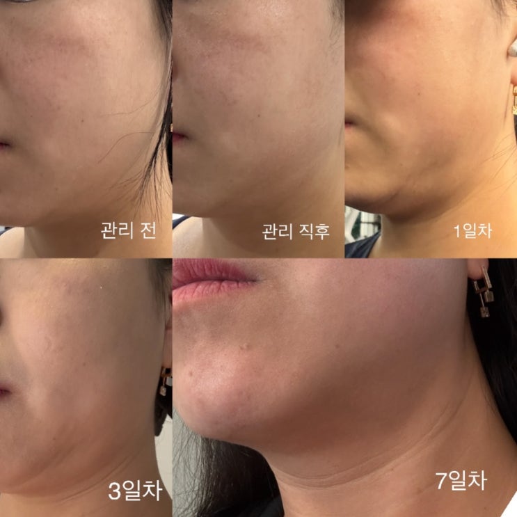  [대전] 이중턱 / 윤곽관리 슈퍼브이턱 '비올렛뷰티&왁싱': 2회차 후기