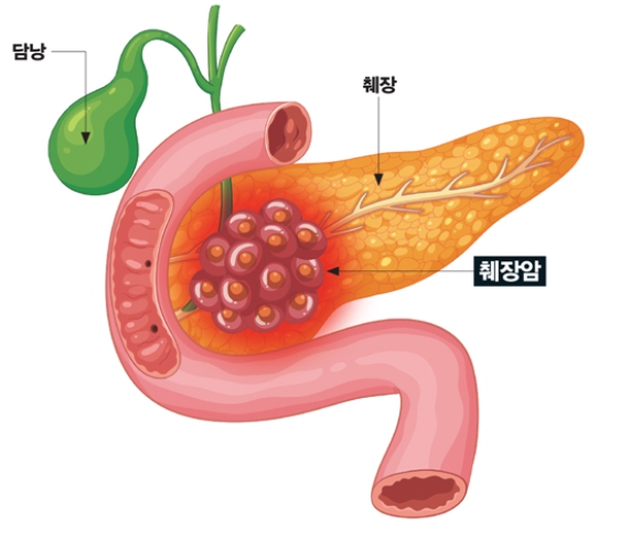   사망률 1위 췌장암! 생존율 2배로 높이는 조기 진단법과 신치료법은 대체 뭘까