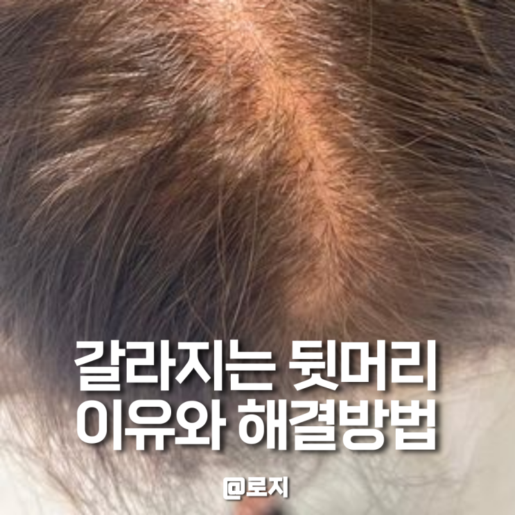  남자 여자 뒷머리 갈라짐 원인해결방법 모류교정펌