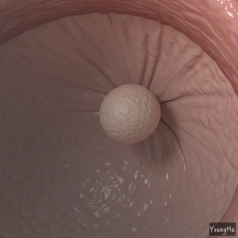 담낭 용종 3mm 6mm 진단받았다면 꼭 알아야 할 포인트