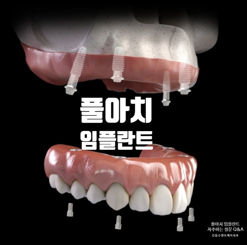 수원 풀아치 치과 무치악 풀아치 임플란트 비용과 시간
