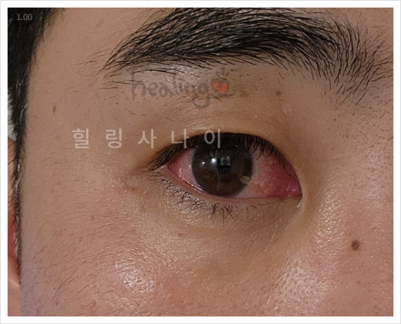아이봉 종류 총정리!(눈세척 세안액, 가격)