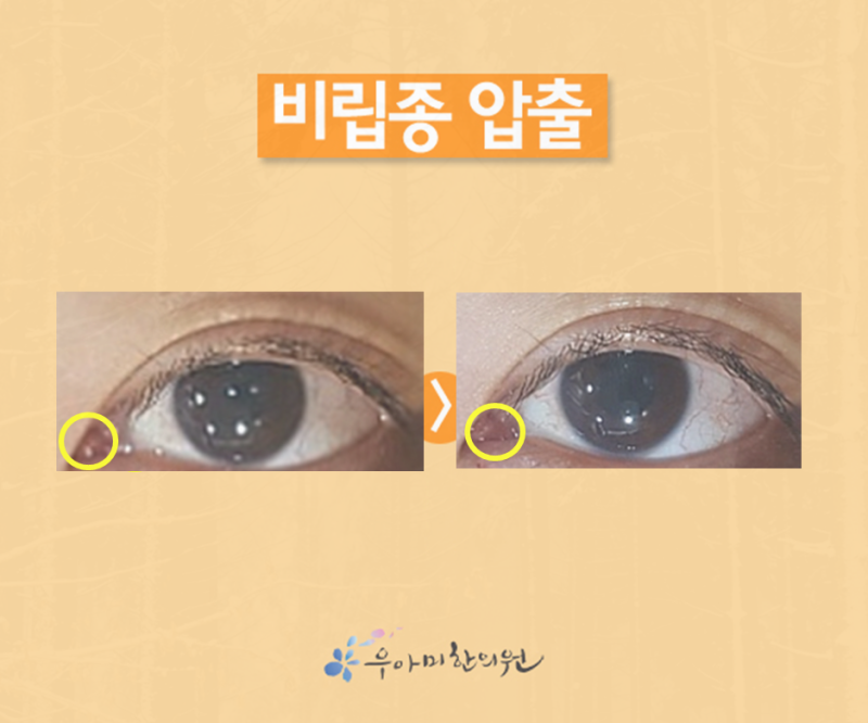 눈 앞머리 비립종 원인, 압출 의료진의 중요성