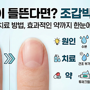 손톱 조갑박리증 원인 치료 방법, 약