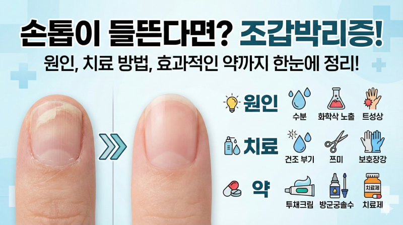 손톱 조갑박리증 원인 치료 방법, 약