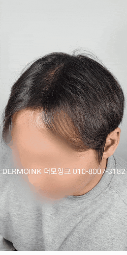  강남 정수리 가르마 커버, 40대 남성의 자신감을 되찾아 준 방법