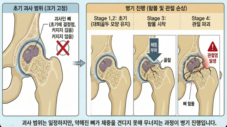  고관절 골괴사 - 선생님, 저는 몇 기 인가요? (골괴사 국제 분류 기준 제1저자)