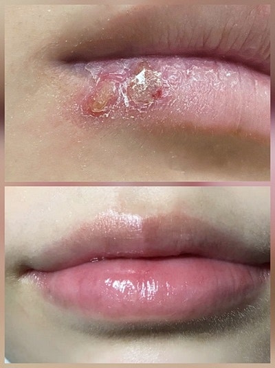 입술포진 에스로반 영양제 효과? 시너지 효과 나타낸 방법