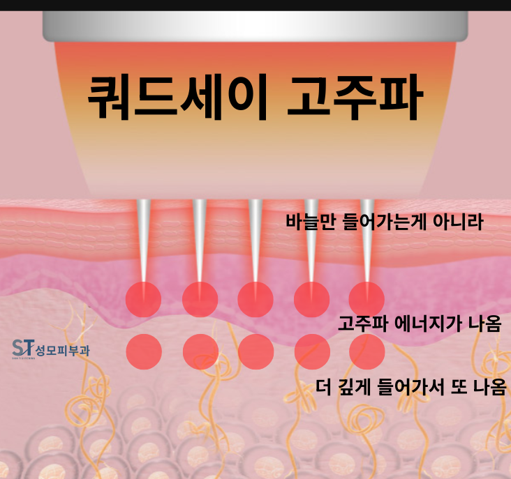 쿼드세이 효과, 원리 (1) - 미세바늘고주파 RF