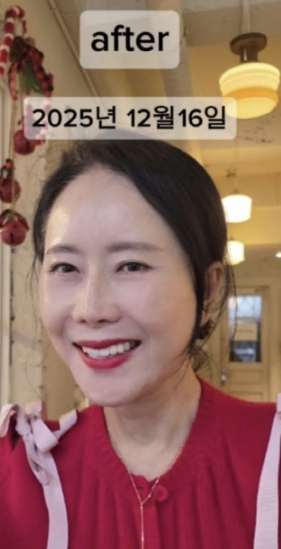   63세 윤영미, 9kg 감량 성공 후 안면·목거상까지! "너무 예뻐졌다고" 비결 고백