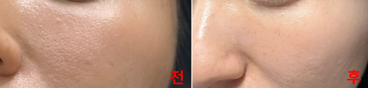  홍대 눈밑꺼짐 다크서클 울트라콜 콜라겐주사 내돈내산 찐후기