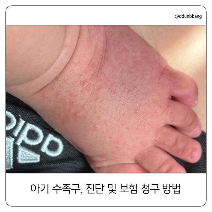  아기 수족구병, 진단과 보험 청구 방법  (Feat. 인카금융서비스)