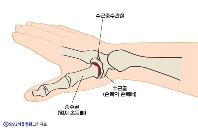 손목과 엄지손가락이 만나는 부위의 연골이 닳으면서 발생(엄지손가락 관절염=무지수근중수....