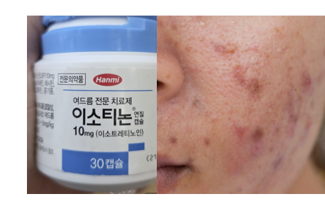  이소티논 처방 복용법 술 가격 효과 여드름 후기
