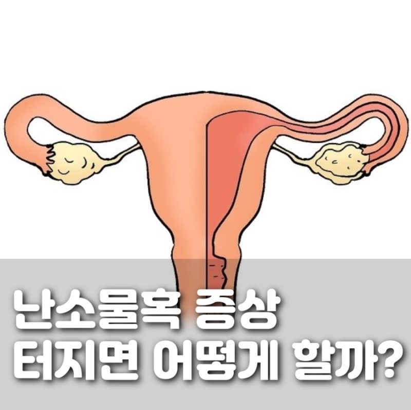 난소물혹 증상 통증 원인 터짐 수술
