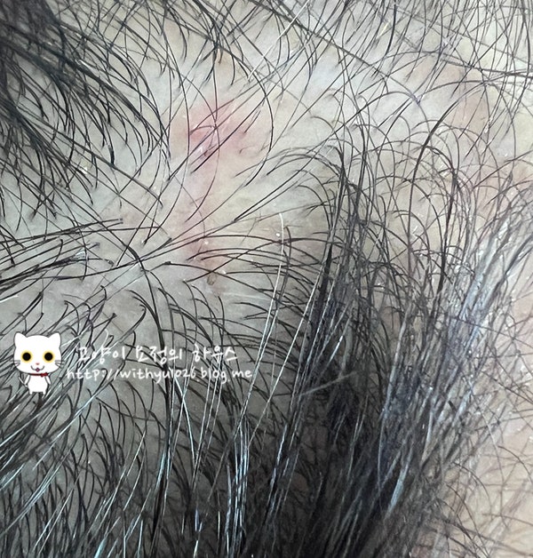  남편인생 첫 성형수술 후기 - 5. 내시경이마거상술+추미근 절제 후기(한달 경과 병원 방문 ~ 2달 후기)