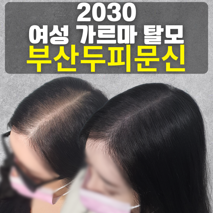  2030대 여성 가르마탈모, 부산 두피문신으로 해결한 실제 후기 & 비용 총정리