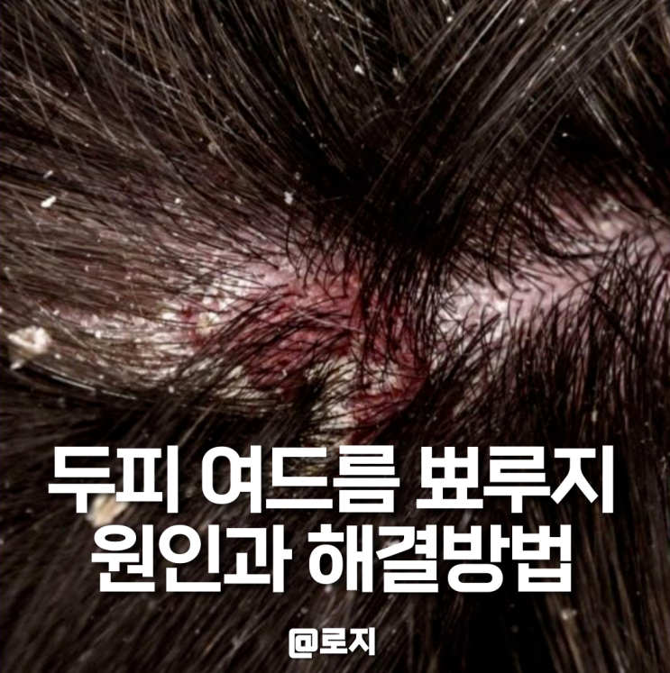 두피 여드름 뾰루지 생기는 원인과 해결방법