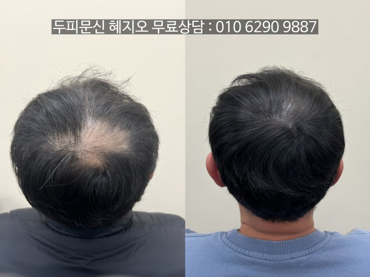  인천 남자 정수리 원형탈모 10년 차 미대 출신 원장이 커버하면 얼마나 달라질까?