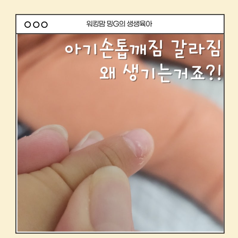 아기손톱깨짐 , 손톱 갈라짐 보고 깜짝 놀랐어요｜수족구 후유증 경험담