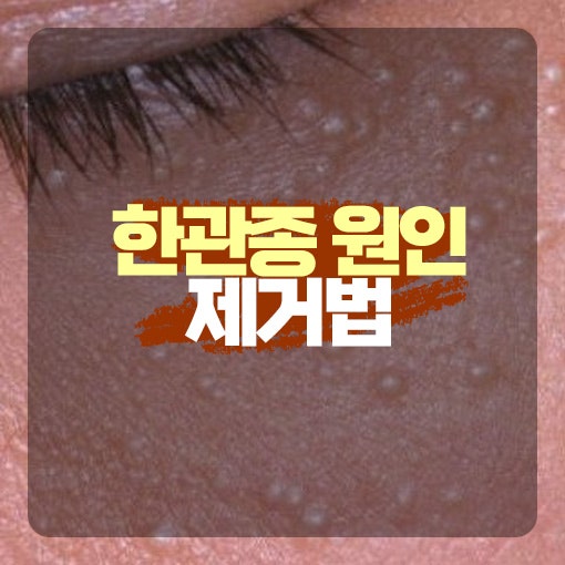 한관종 원인부터 제거, 연고로 관리할 수 있는 방법