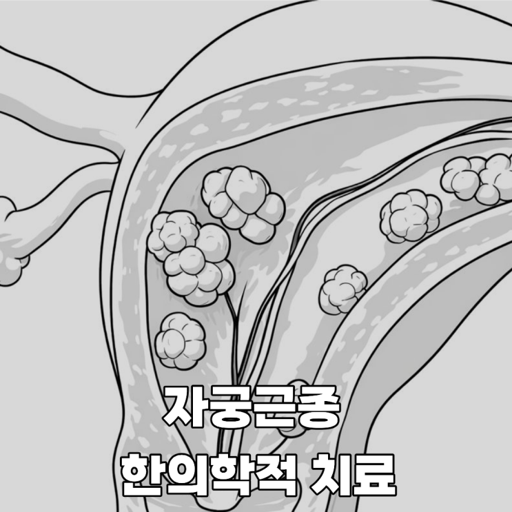  한의학에서 말하는 자궁근종 치료, 왜 주목받을까?