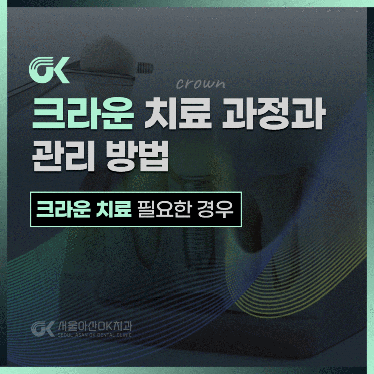  미사 충치치료, 깨진 치아 보호에 적합한 크라운