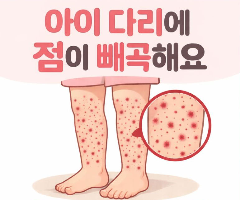 소아자반증 아이 다리에 멍이 퍼진다면