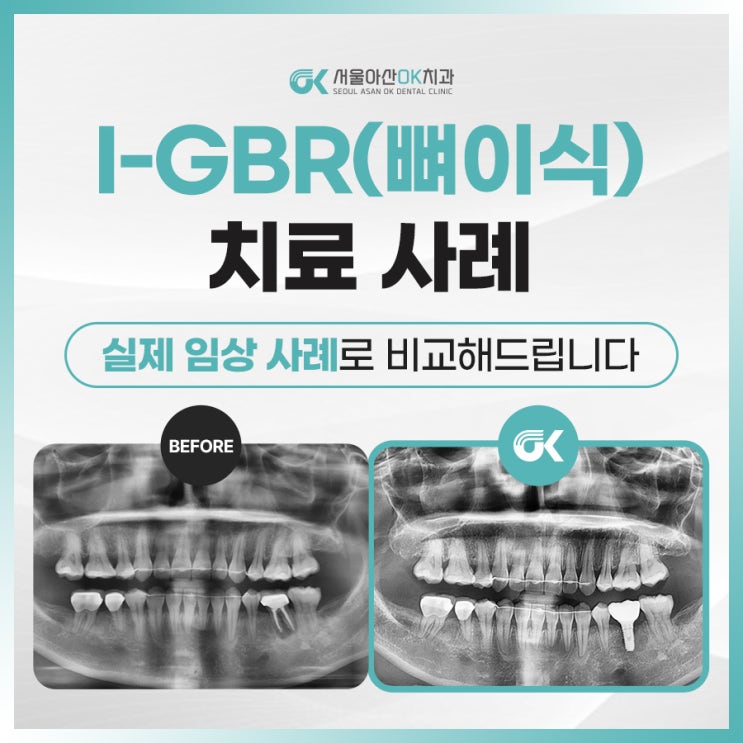  [임상사례] 하남치과추천 I-GBR 임플란트 치료사례