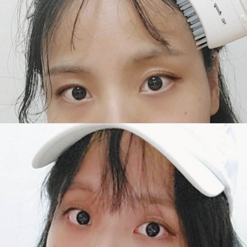 갑상선기능항진증 안구 돌출 변화 후기