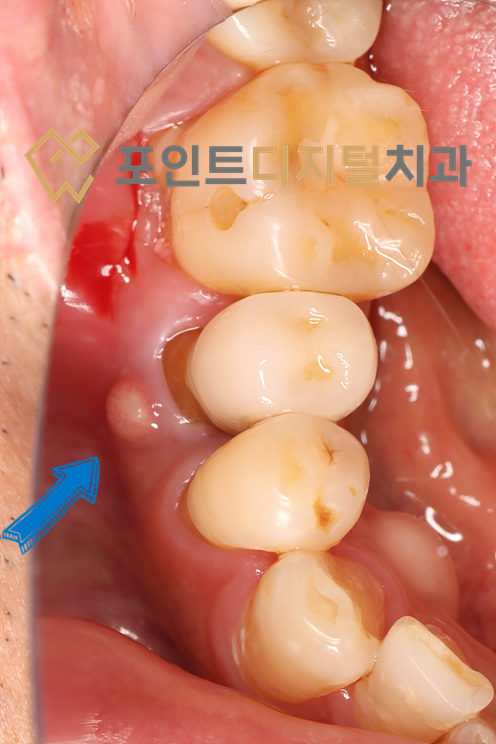  [탕정역치과]  치근단 농양으로 발치(발치즉시 임플란트, 덴티움) + 삐뚫어진 치아방향을 바로잡아봅시다 / 천안 아산
