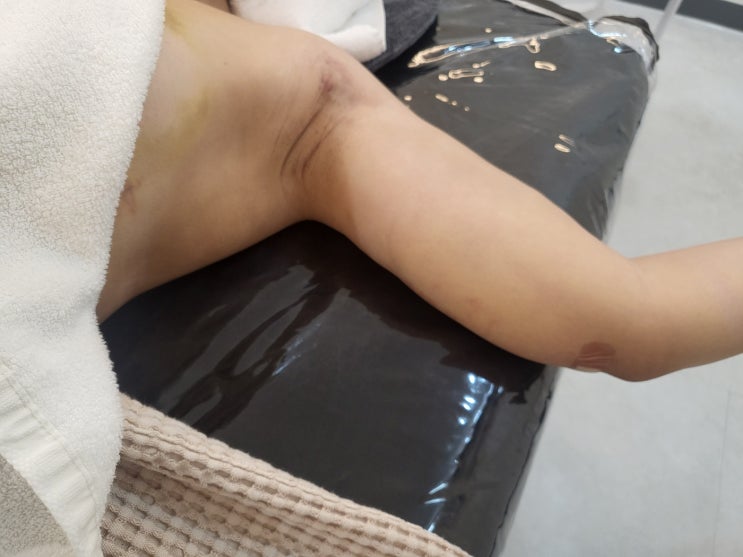  팔 바본관리, 지방흡입 후 울퉁불퉁한 결감 왜 생길까요?