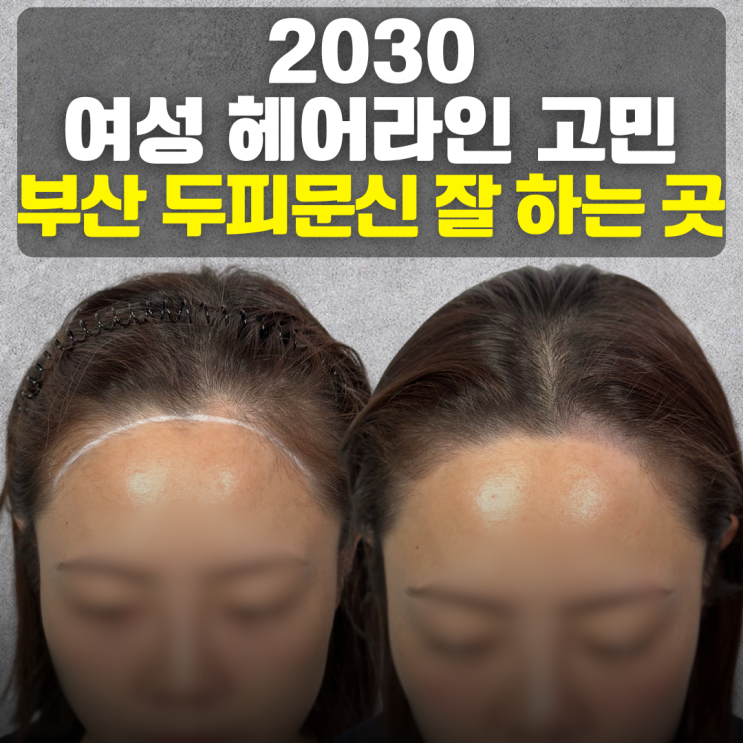  부산 두피문신 잘하는 곳 | 2030 헤어라인 고민 완벽 해결법