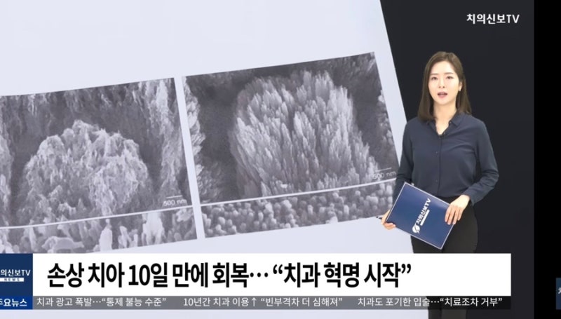 [치과 혁명] 바르기만 하면 치아가 재생된다? 손상된 에나멜 복원하는 '꿈의 젤' 등장
