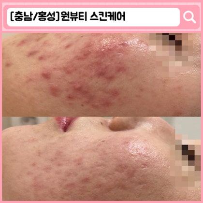 '원뷰티 이지다 홍성내포점' 홍성 피부관리, 홍성내포 피부관리, 홍성 왁싱