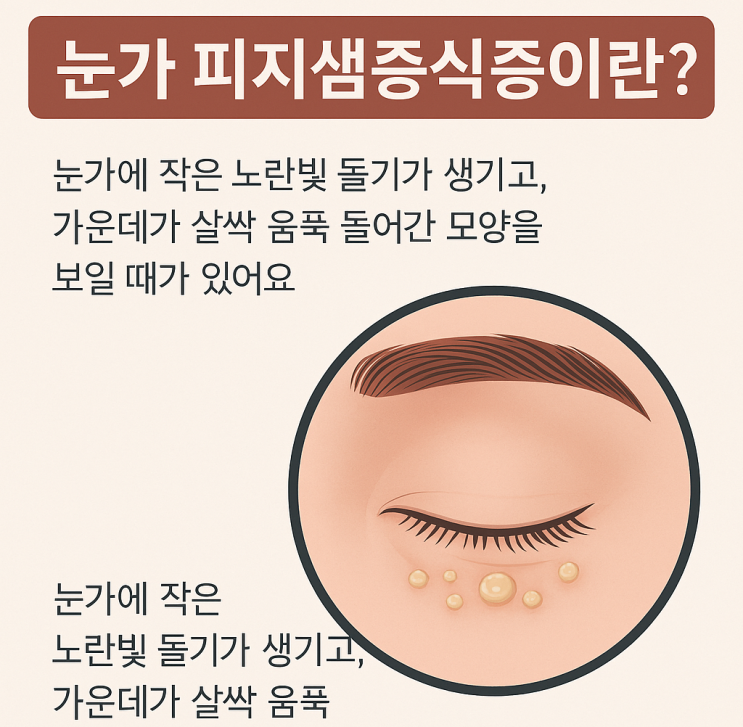  눈가 피지샘증식증 관리법, 재발 없는 피부 케어 꿀팁