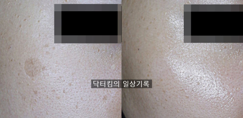 얼굴 잡티 흑자 제거, 레이저 치료 및 관리 방법 [by 피부과 전문의 닥터킴]