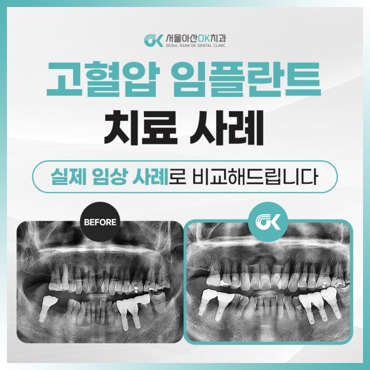  [임상사례]미사의 봄날을 닮은 편안한 치과, 고혈압 임플란트