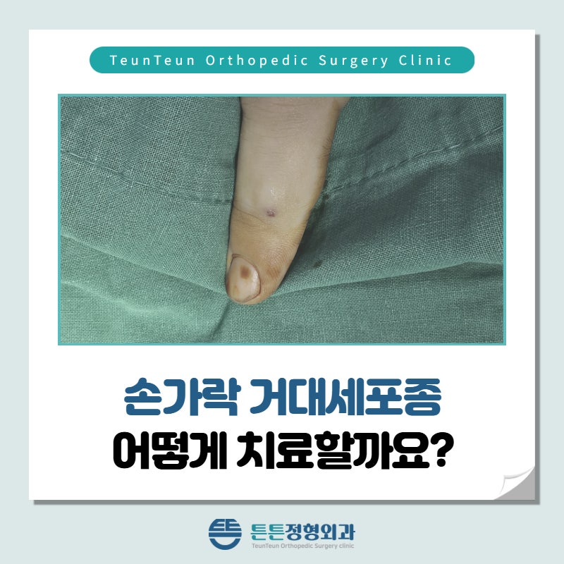 청주 정형외과 손가락 거대세포종 어떻게 치료할까?