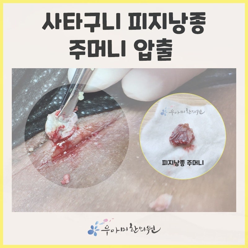 여자 생식기 종기,원인, 재발 방지와 치료법 정리