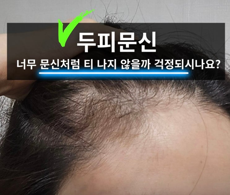  두피문신, 망하는 공통점 / 주의하세요