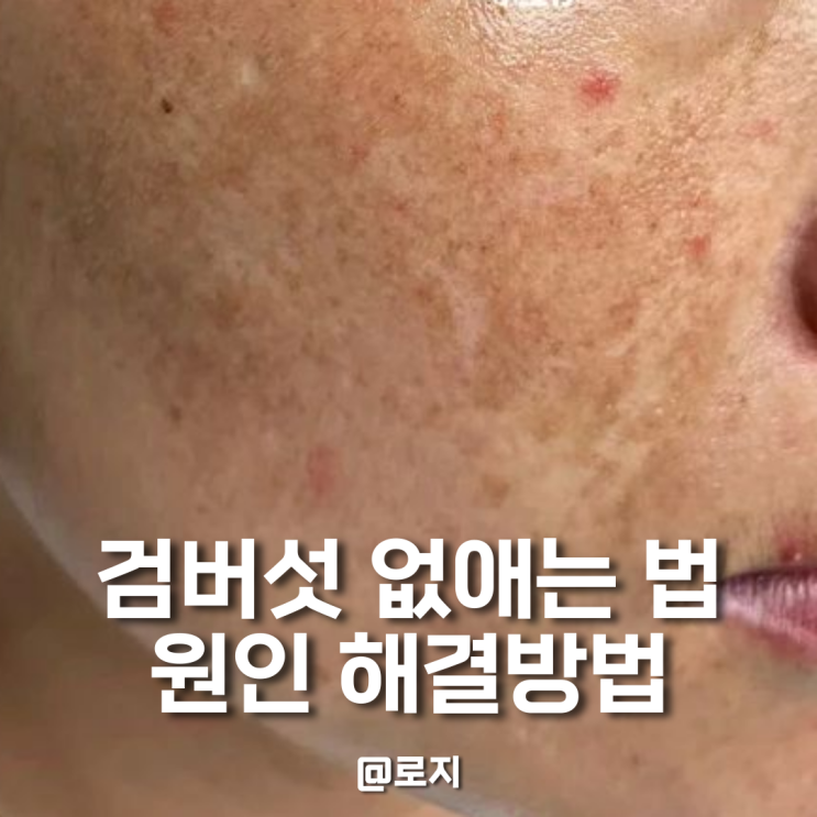  얼굴 검버섯 없애는 방법 원인부터 해결 방법