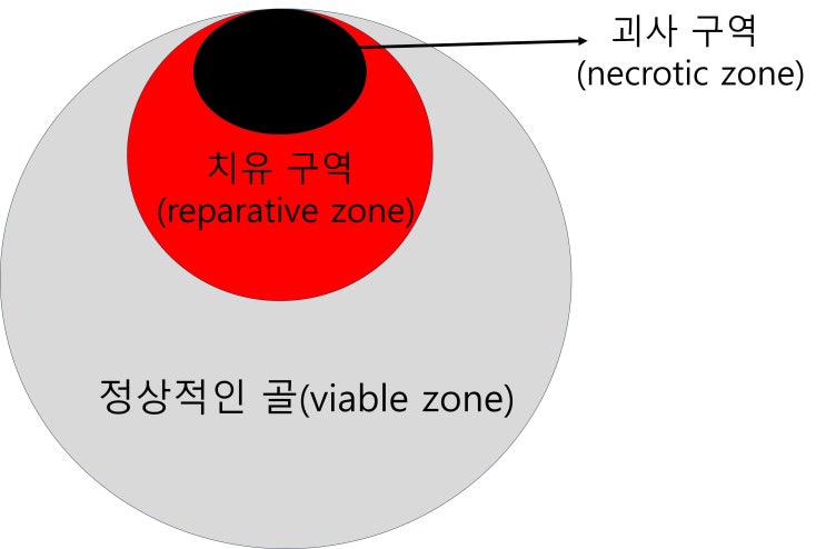  대퇴골두 골괴사에도 우리 몸의 치유 과정이 있다는 것 알고 계신가요?