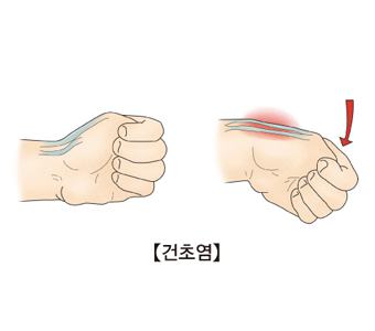 건초염(Tenosynovitis) 손목이 너무 아픈 직장인, 주부... 힘줄에 문제 생기기 전에 이렇게 하라