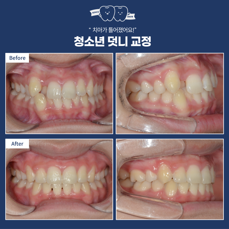  덧니와 돌출입, 발치 교정에 대한 오해와 진실,"멀쩡한 생니를 4개나 뽑아도 괜찮을까요?"